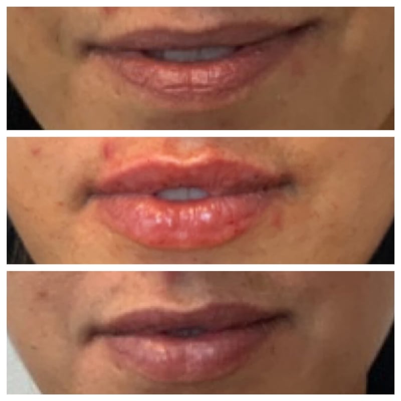 Lip Filler before, after, and 1 month later with Restylane Refyne Treatment Bespoke Rx